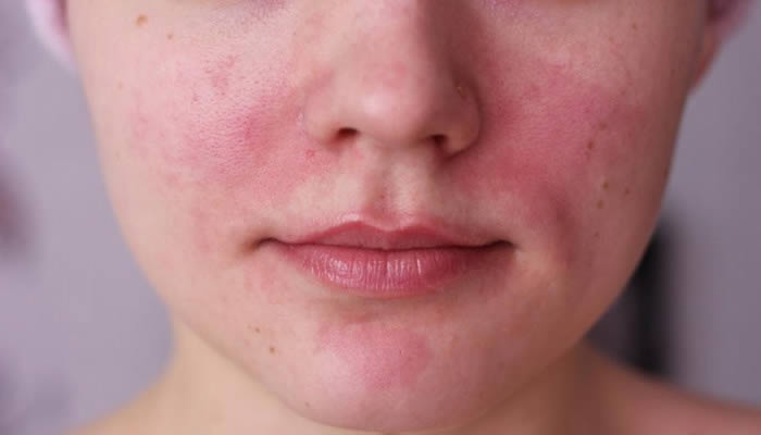 acne rosacea tratamiento natural