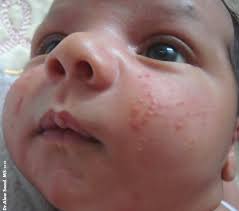  acne neonatal duracion