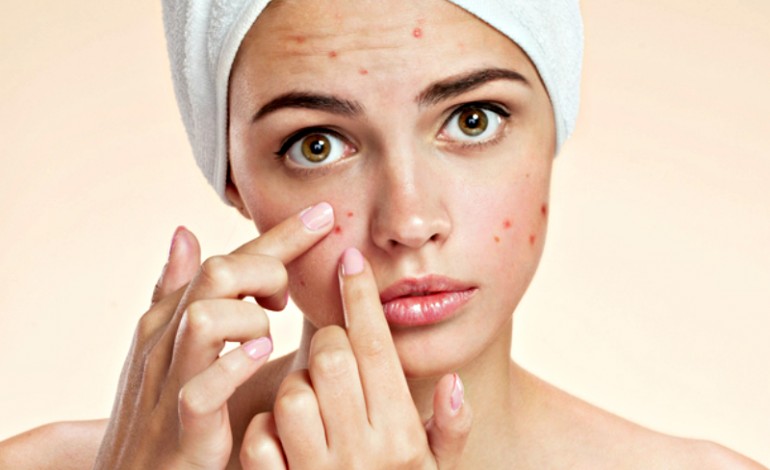  acne leve antes y despues famosos