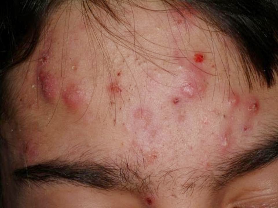 acne quistico causas