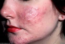 acne rosacea tratamiento natural