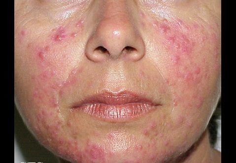  acné rosacea causas