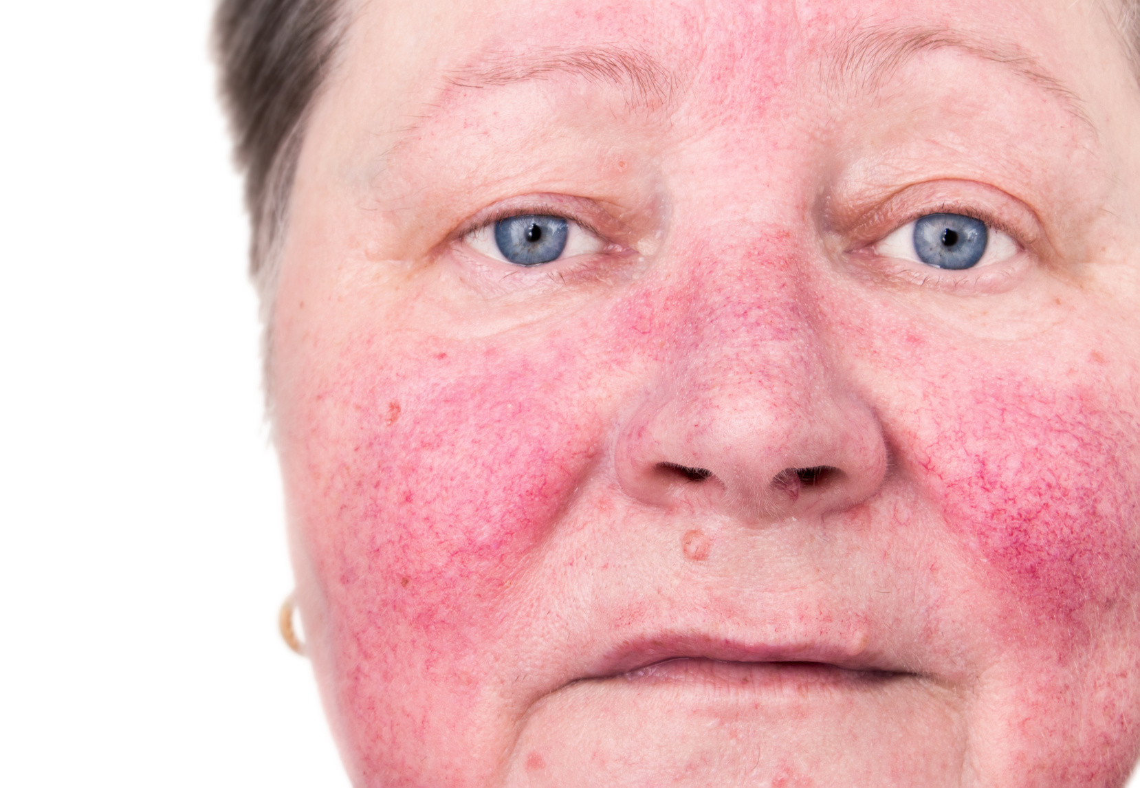  acne rosacea fotos