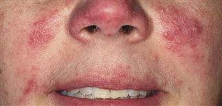  acne rosacea antibiotics