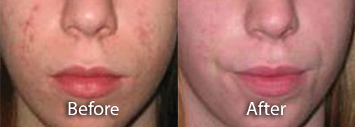  acne rosacea and menopause