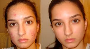  eliminar marcas de acné tratamiento